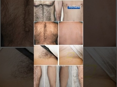 Eliminación de vello con láser antes y después