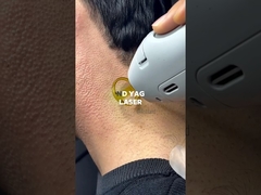 Eliminación láser ND YAG para el cabello oscuro