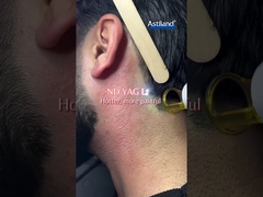 Diodo láser vs. láser ND YAG, ¿cuál prefieres?