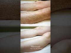 ¡Presentando la última máquina de depilación con láser de fibra, Astiland Fibermax!